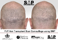HAIRTATTOO.CA | SMP Scalp Micropigmentation Toronto